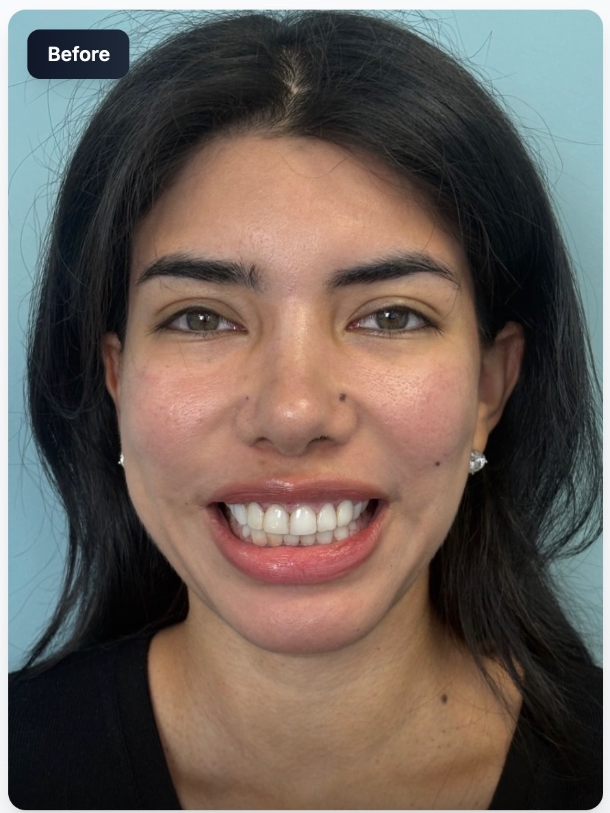 Before smile transformation
